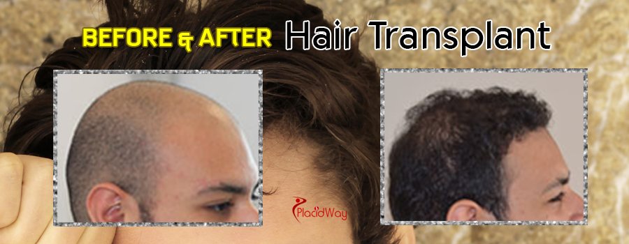 Hair Transplant